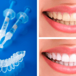 blanquemiento dental por felulas