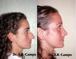 rinoplastia antes y después DR. Rodriguez