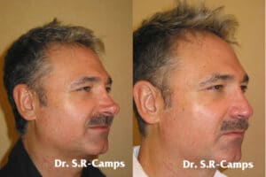 rinoplastia antes y después DR. Rodriguez