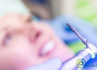 Lo que debes saber sobre los implantes dentales sin cirugía implantes con cirugía guiada