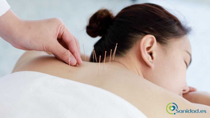 beneficios de la acupuntura