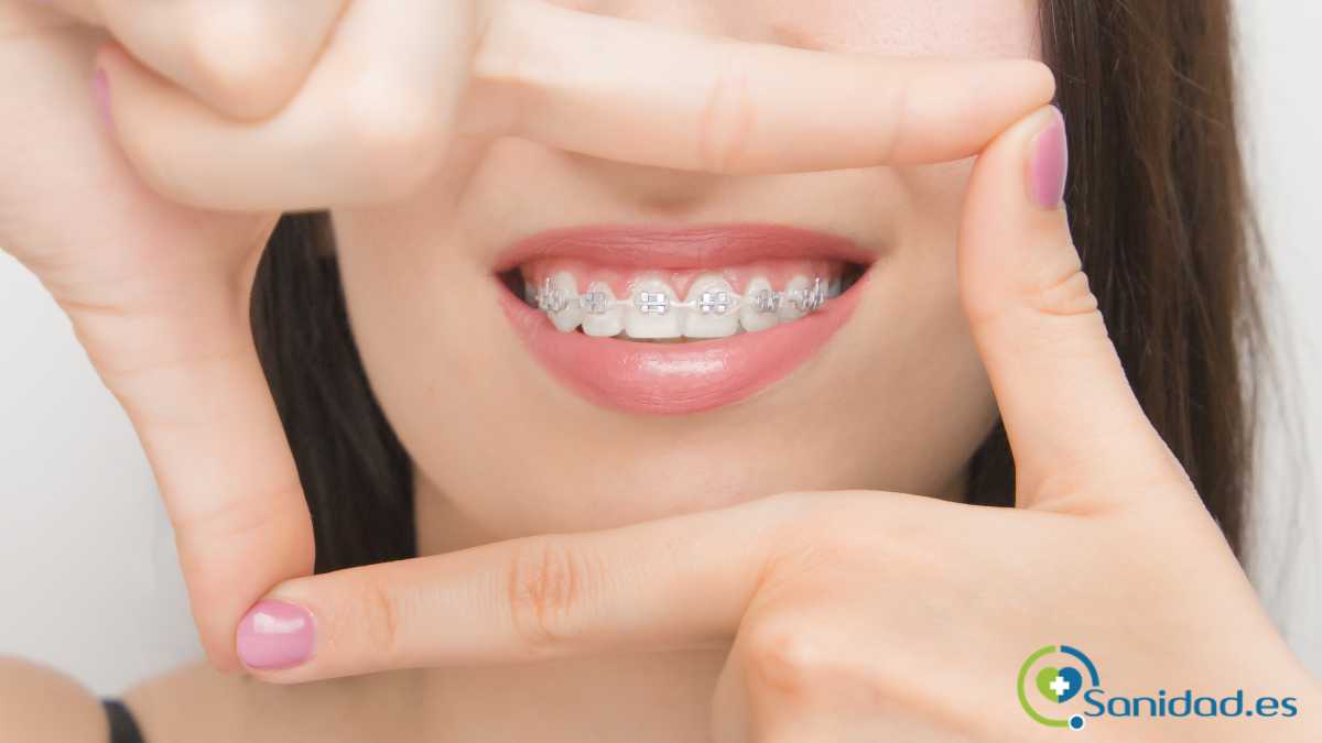 tratamientos de estética dental ortodoncia o carillas