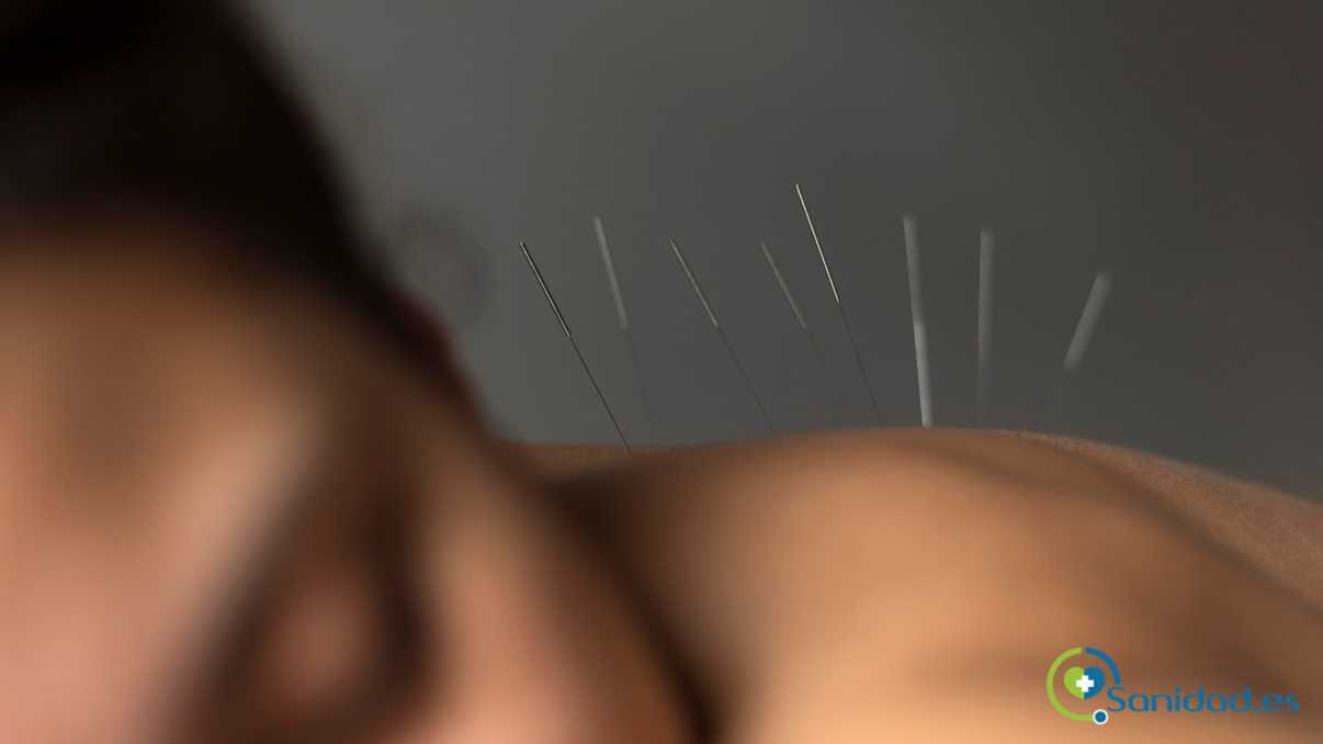 acupuntura para combatir la ansiedad
