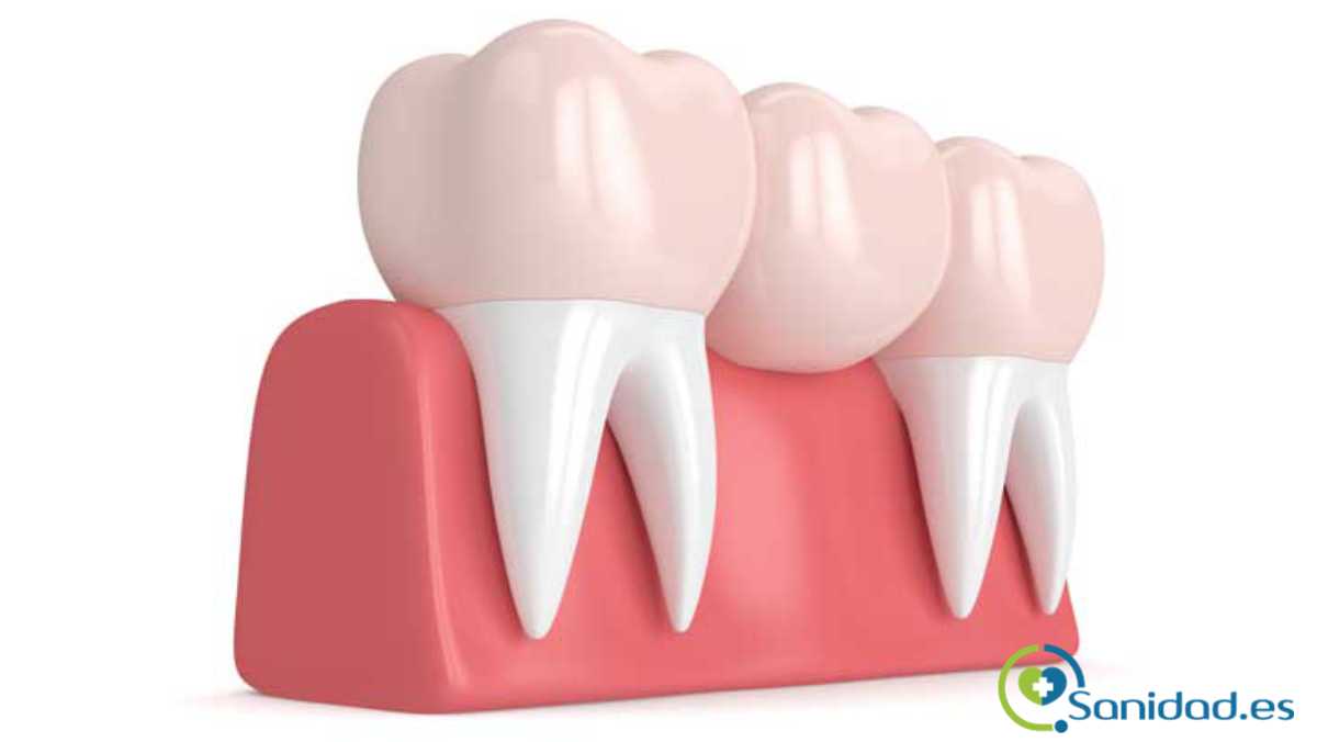 tipos de prótesis dentales