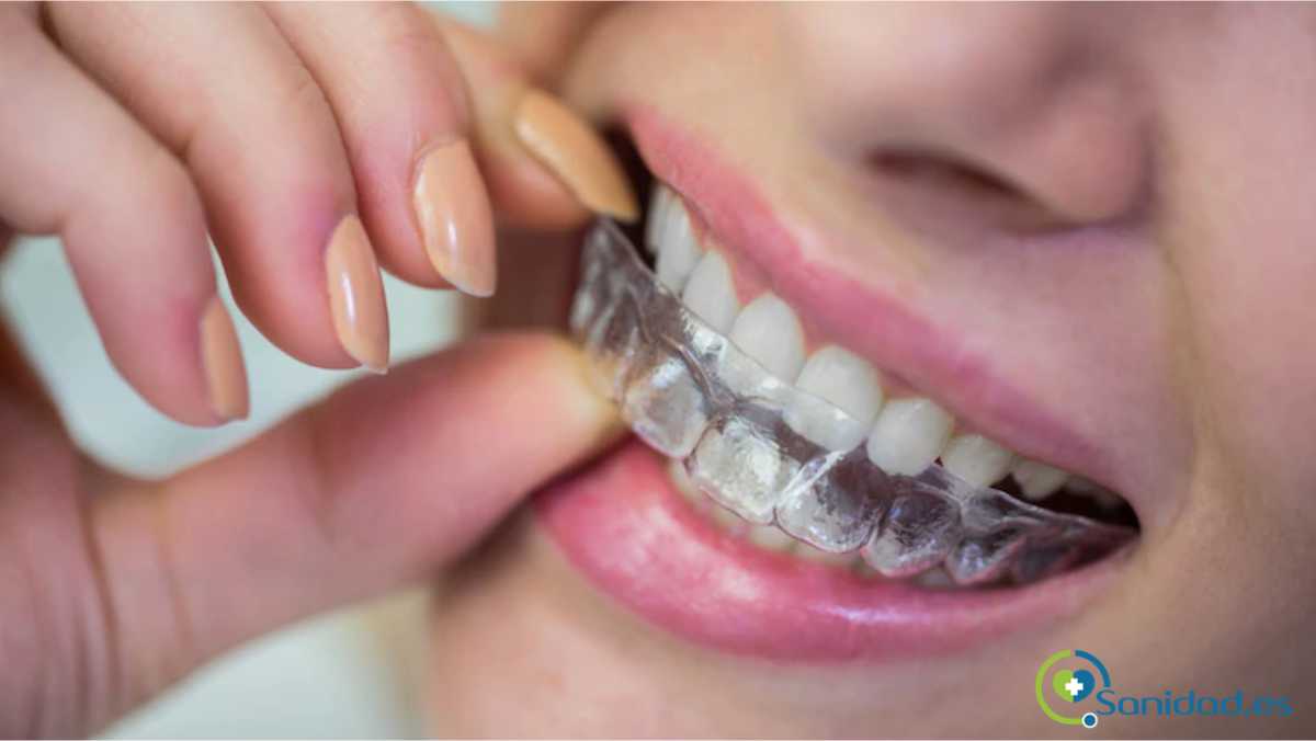 sistema de ortodoncia removible