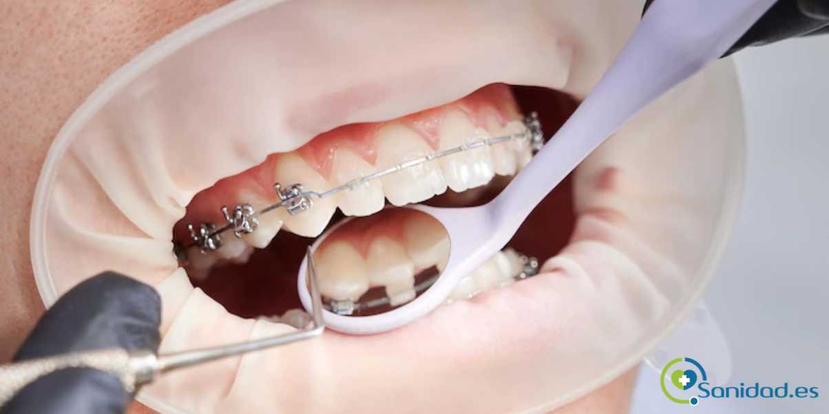 sistemas de ortodoncia fijos