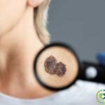 Síntomas y signos de alerta del melanoma: aprende a identificar señales para una detección temprana signos de alerta del melanoma