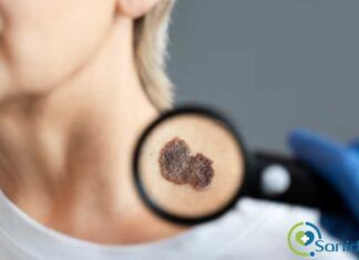 signos de alerta del melanoma