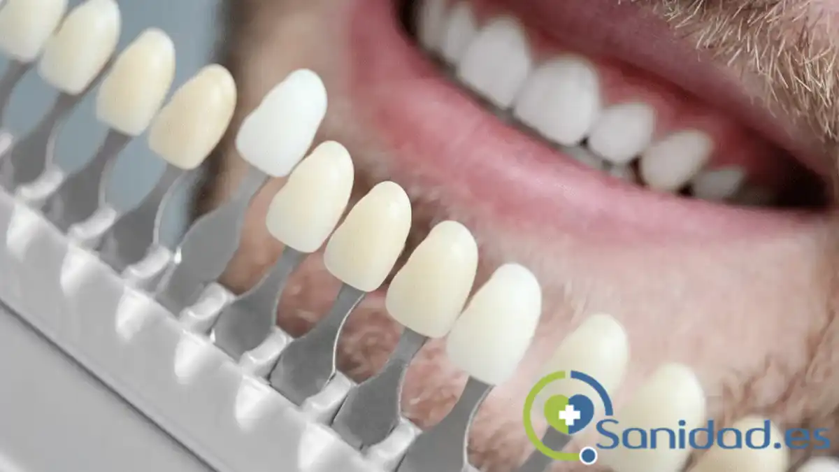 Ventajas y desventajas de las carillas dentales