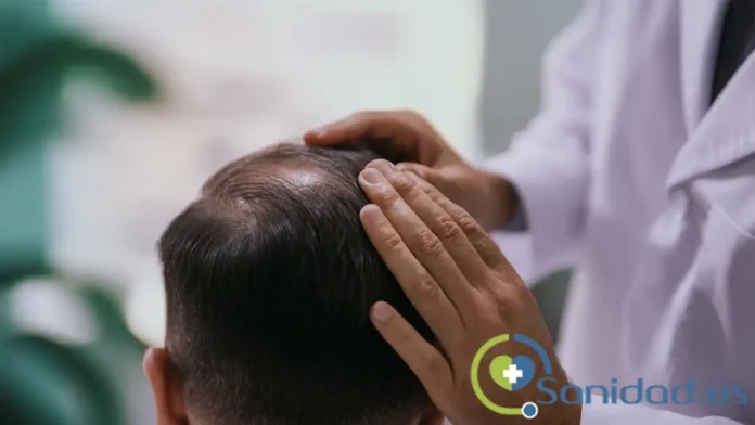 Quién puede hacerse un injerto capilar