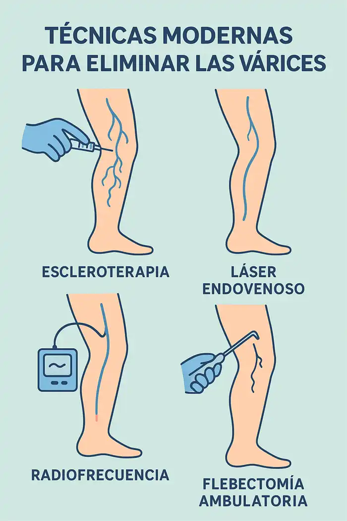 Técnicas modernas para eliminar las várices infografía
